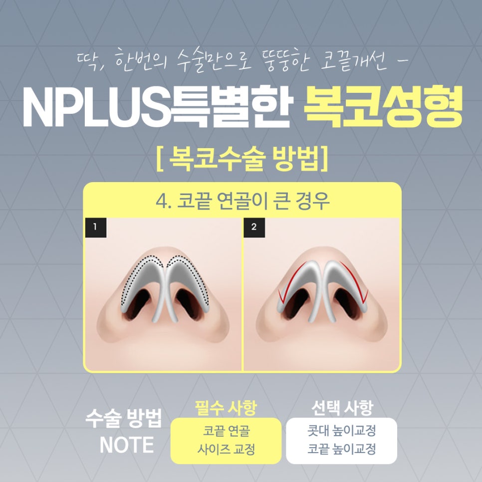복코수술후기 조화로운 얼굴 라인 관련 이미지 9