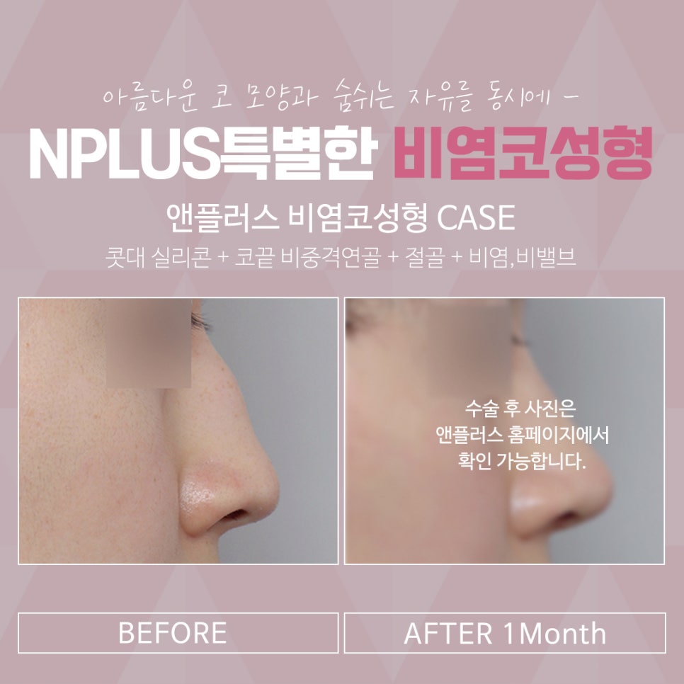 Nasal Surgery Review: Make Sure You Understand It Clearly image 16