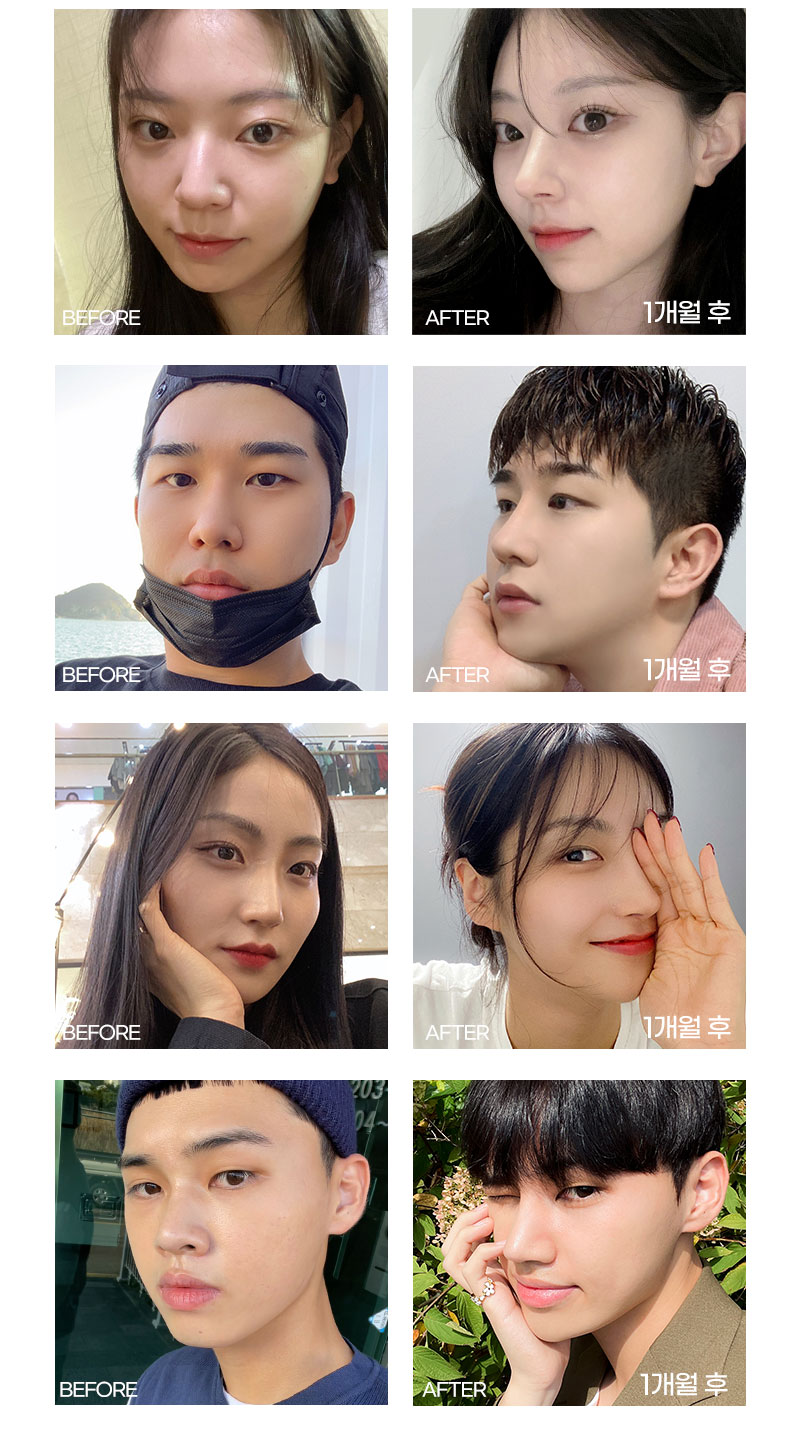 🙌앤플러스의원 코성형 2024수험생이벤트🙌 관련 이미지 5