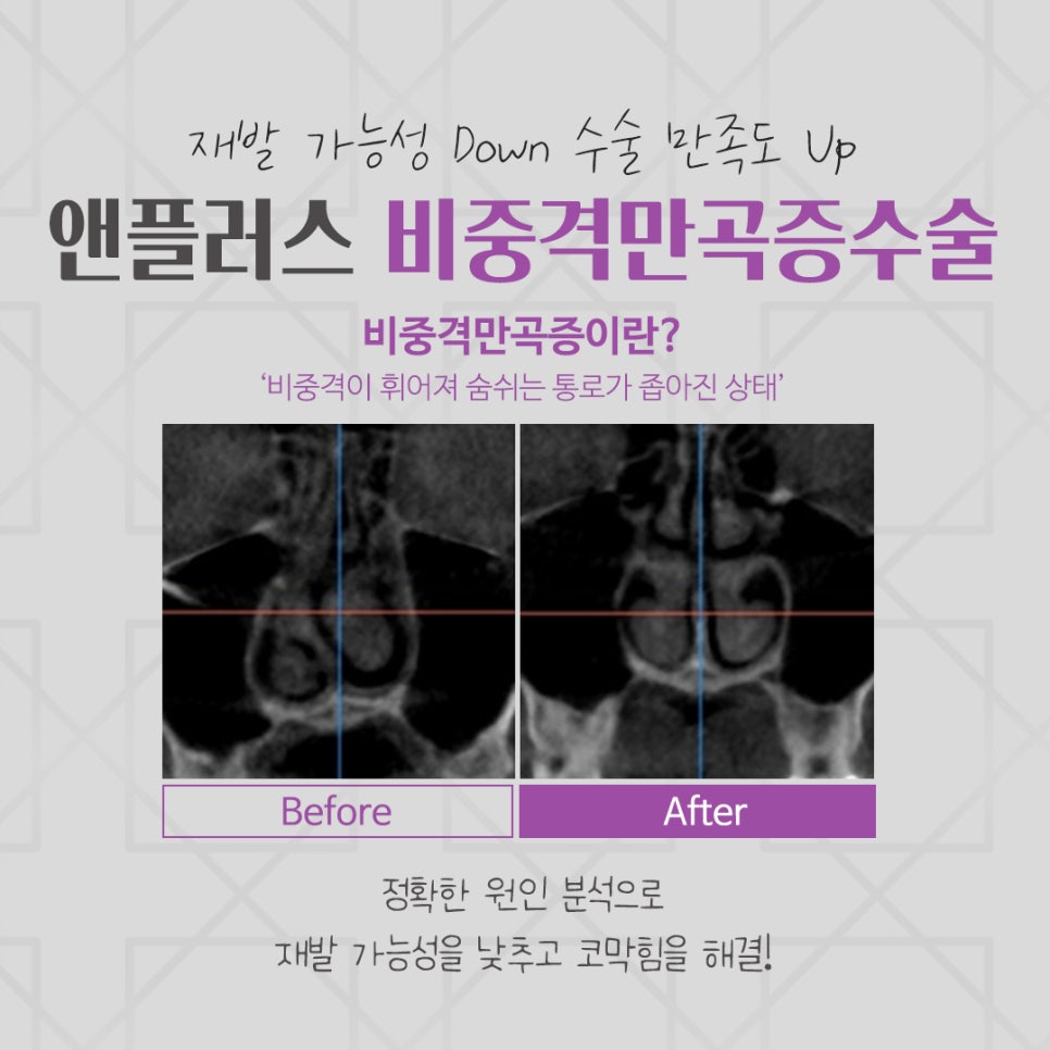 비중격만곡증수술 원인을 자세하게 관련 이미지 4
