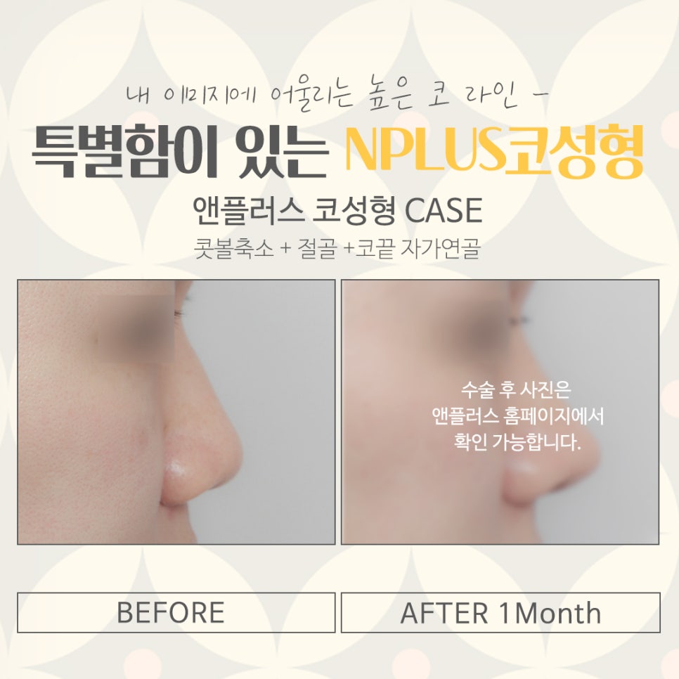코성형잘하는병원에 대해 알아보고 관련 이미지 14
