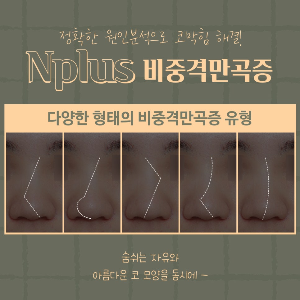Septoplasty Surgery Explained at Gangnam Nose Surgery image 8