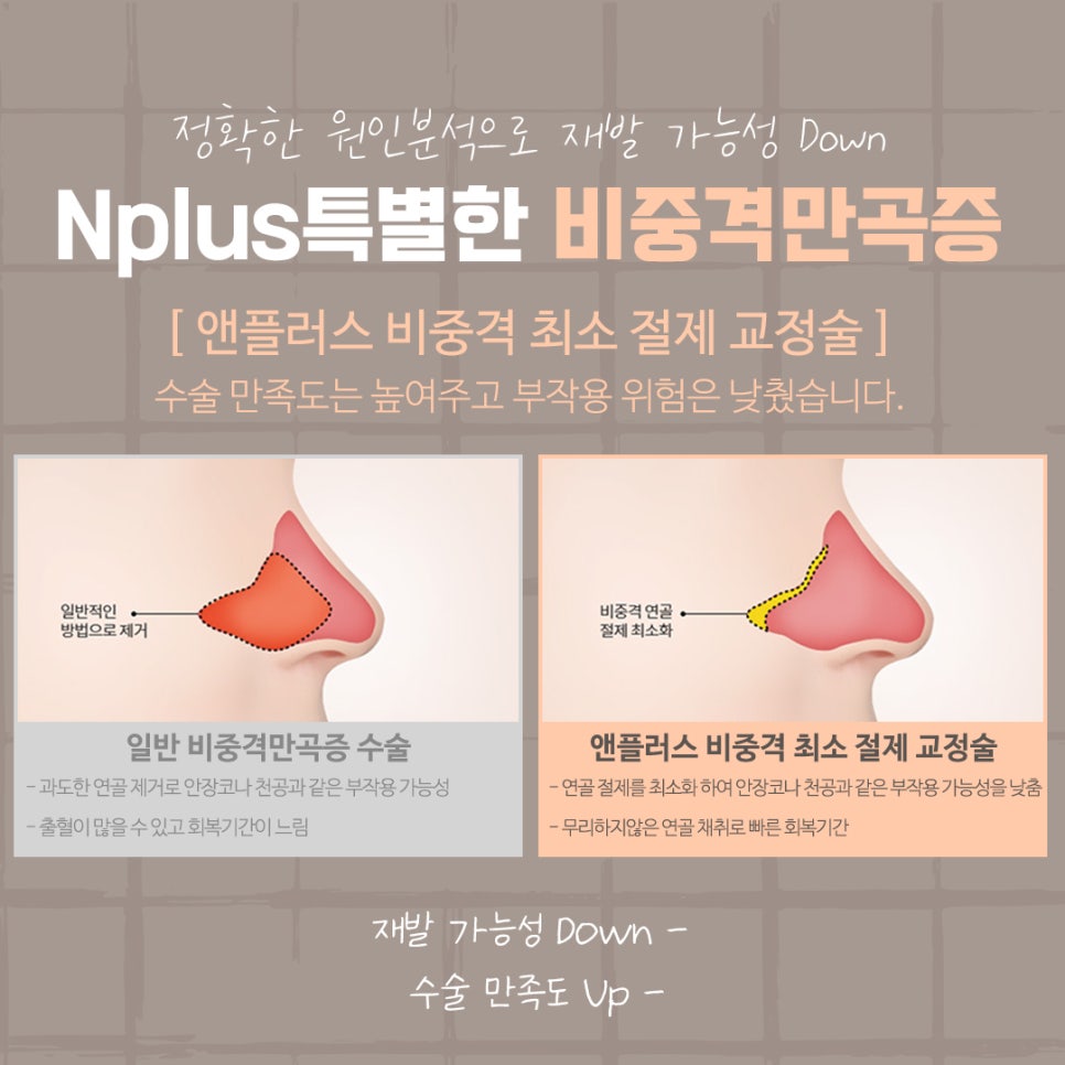 비중격만곡증수술후기 신중하게 고려하여 관련 이미지 9