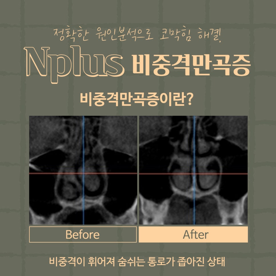 Septoplasty Surgery Explained at Gangnam Nose Surgery image 4