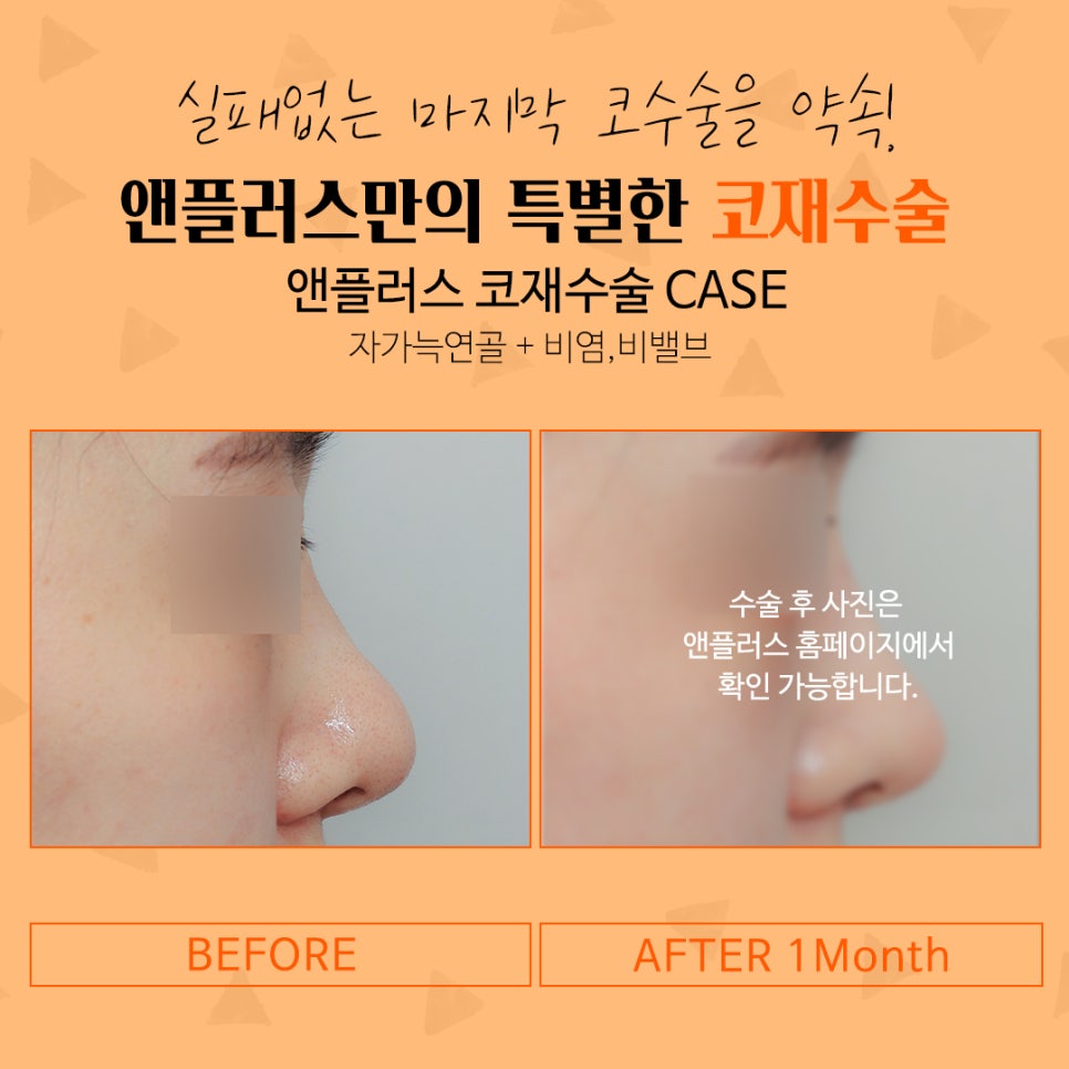 코재수술후기 자연스럽고 예쁘게 관련 이미지 9