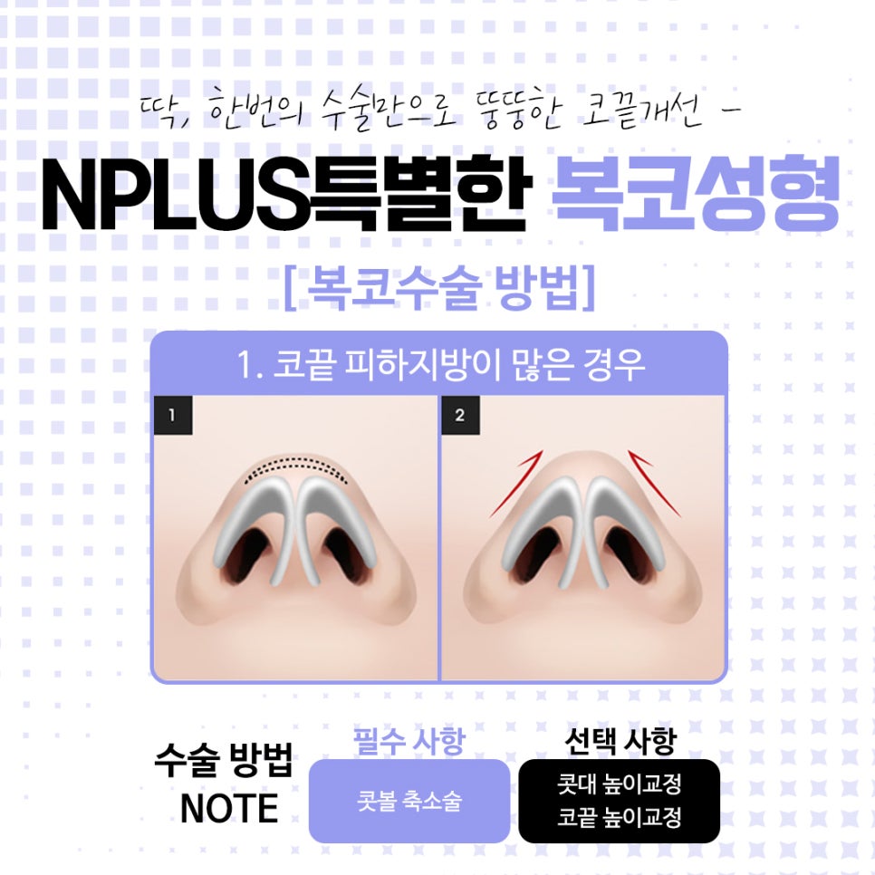 복코수술전후에 대해 자세히 찾아보고 관련 이미지 8