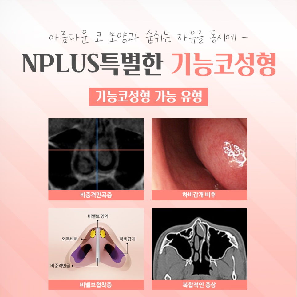 기능코성형전후를 찾아보고 관련 이미지 5