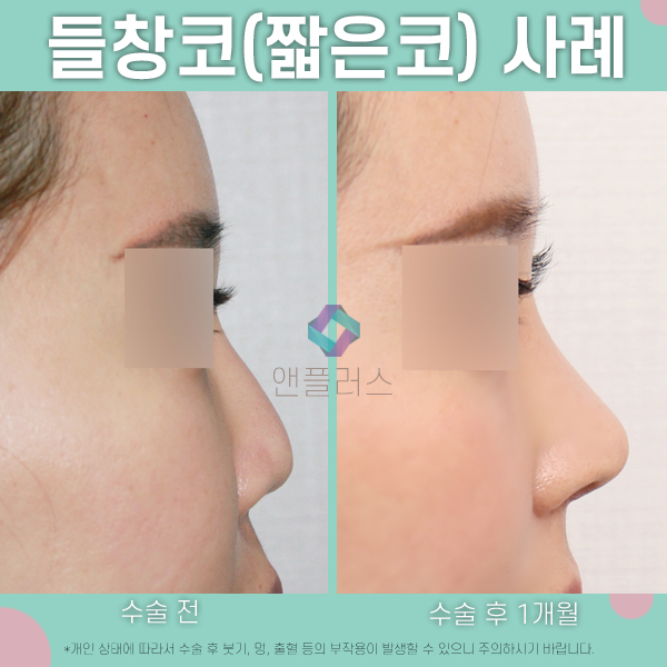 짧은코성형 복합적 교정방법 관련 이미지 3