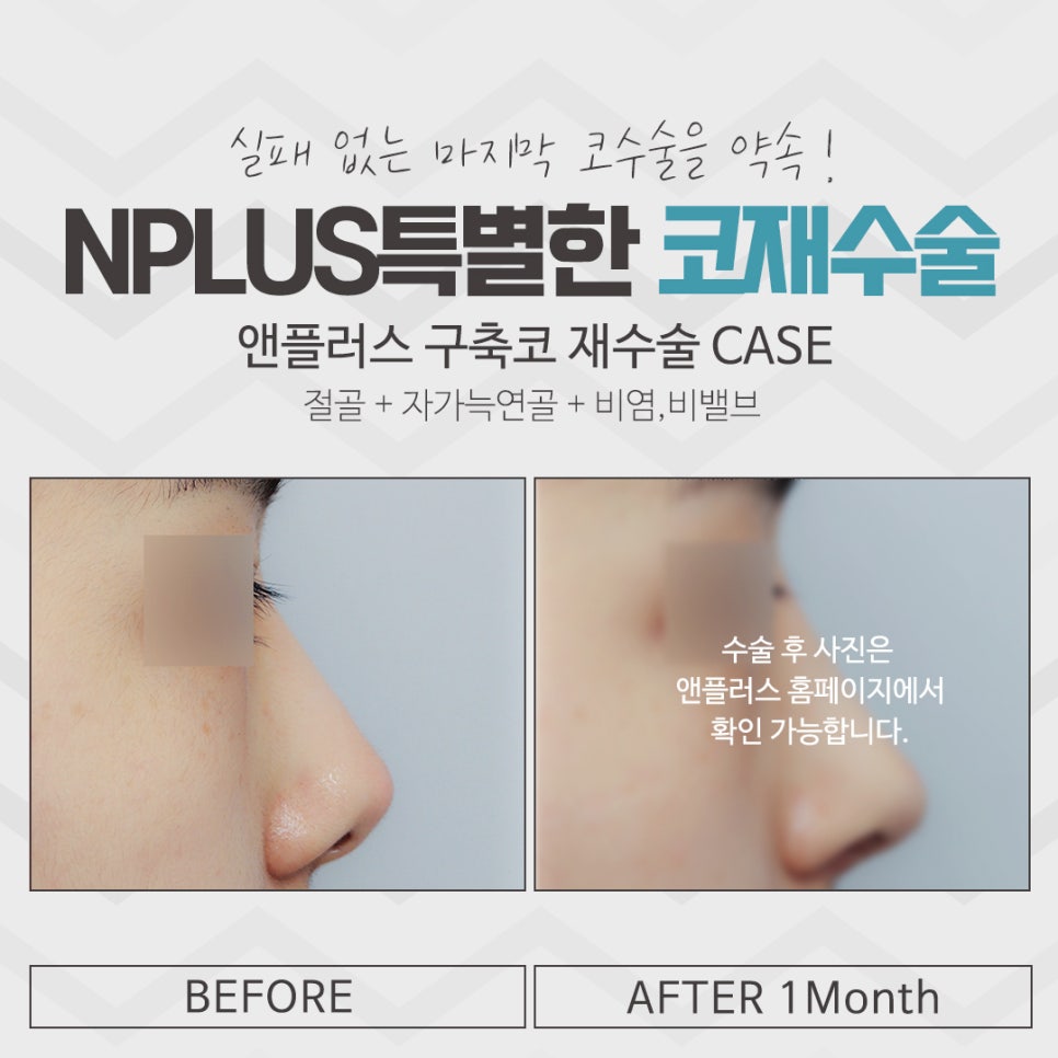 A Clear Difference in Revision Rhinoplasty Plastic Surgery Clinics image 10