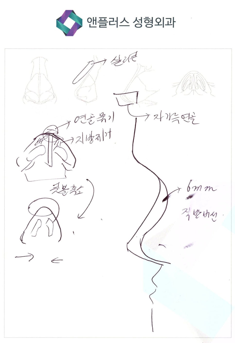 낮은코성형 비염수술도 예쁘게 관련 이미지 5