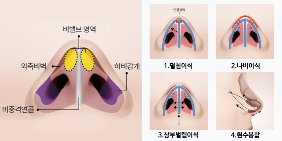 비염코성형에 대한 모든 것 완벽 정리 관련 이미지 10