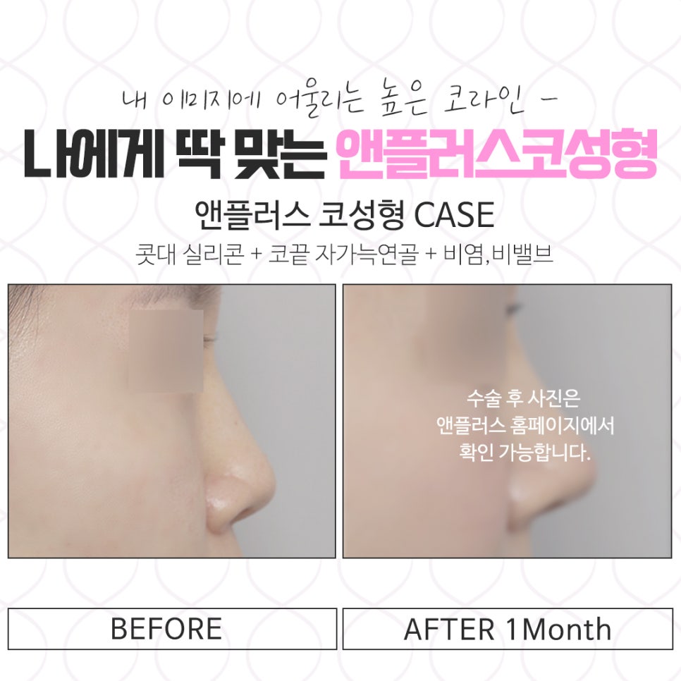 코뼈골절 정확한 진단으로 관련 이미지 13