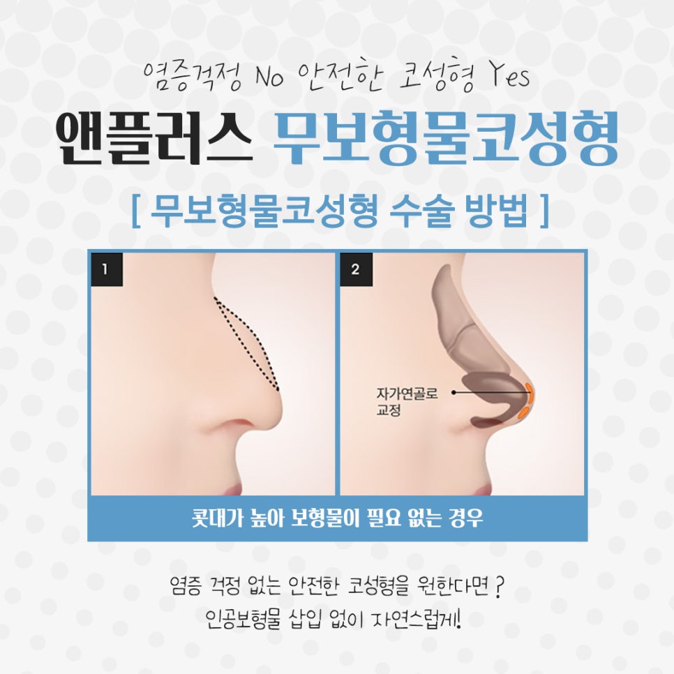 Non-Implant Rhinoplasty: Natural and Safe image 7