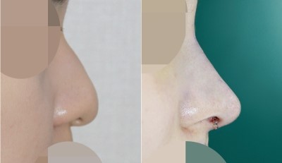 이비인후과코성형 앤플러스_수술사진 전후 관련 이미지 1