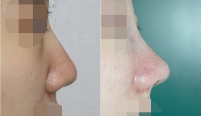 앤플러스 매부리코, 복코 실제 수술 전후사진 관련 이미지 1