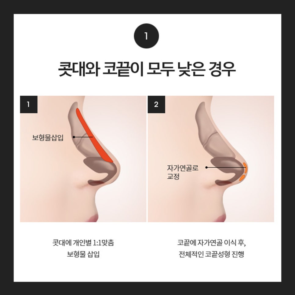 Let’s Find Confidence with a Small, Low Nose and a Beautiful Nose Shape! image 6