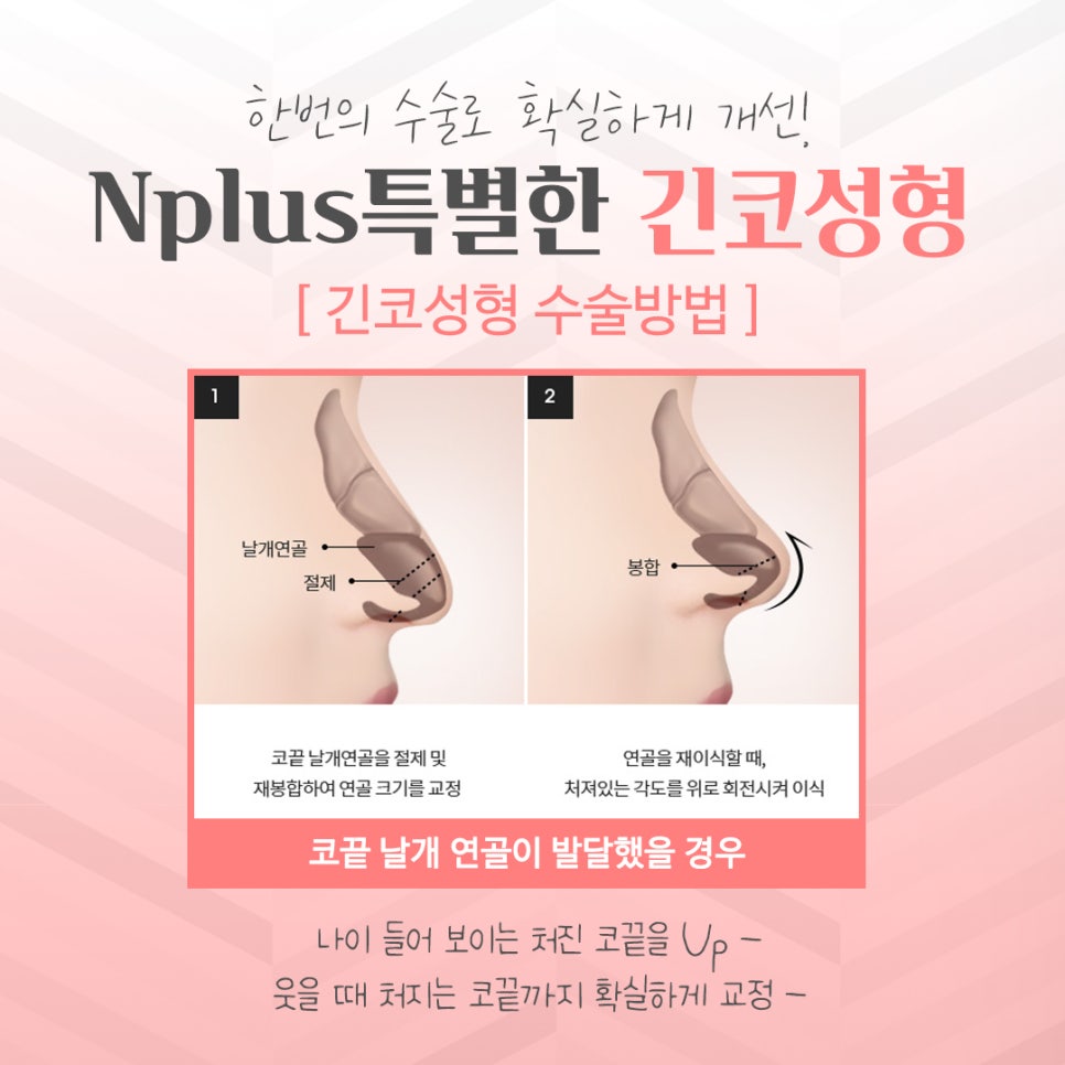 Learn More About Long Nose Surgery in Detail image 8