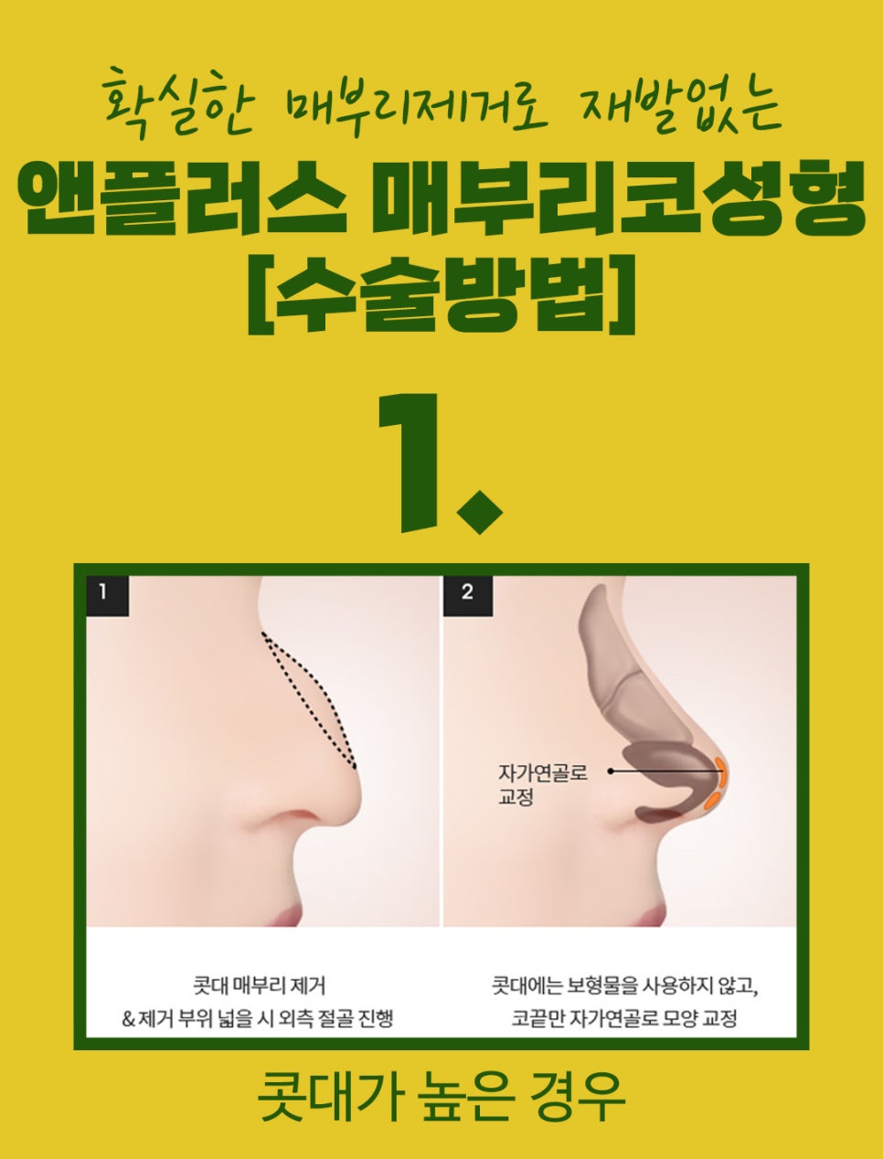 매부리코교정후기_깔끔하게 제거해야 관련 이미지 5