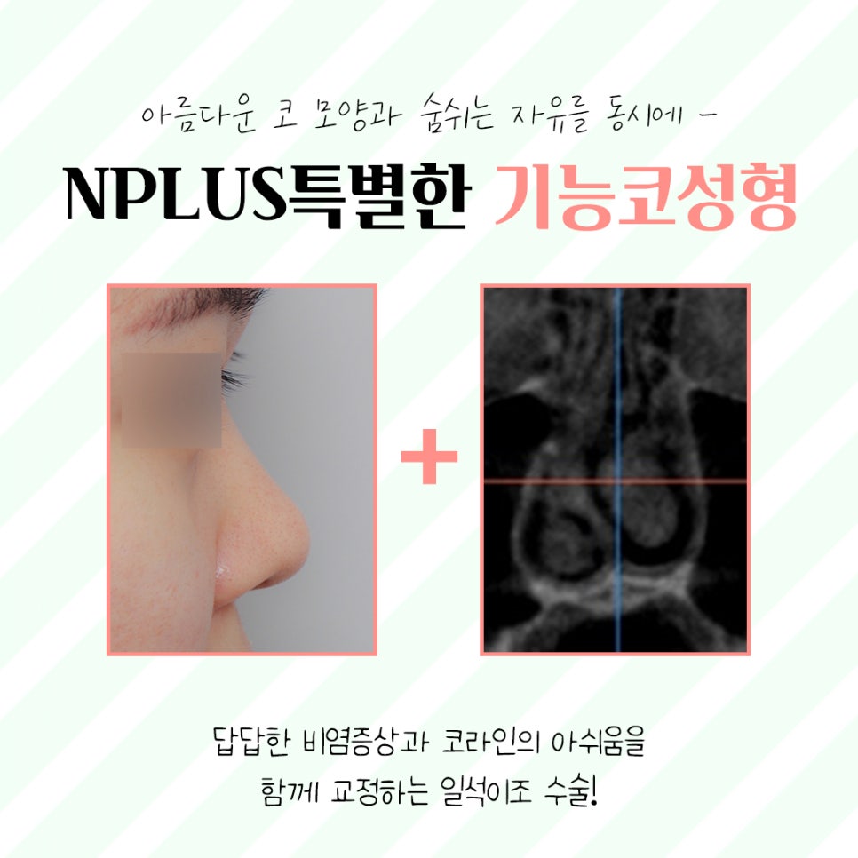 코성형후기 제대로 알아보고 관련 이미지 8