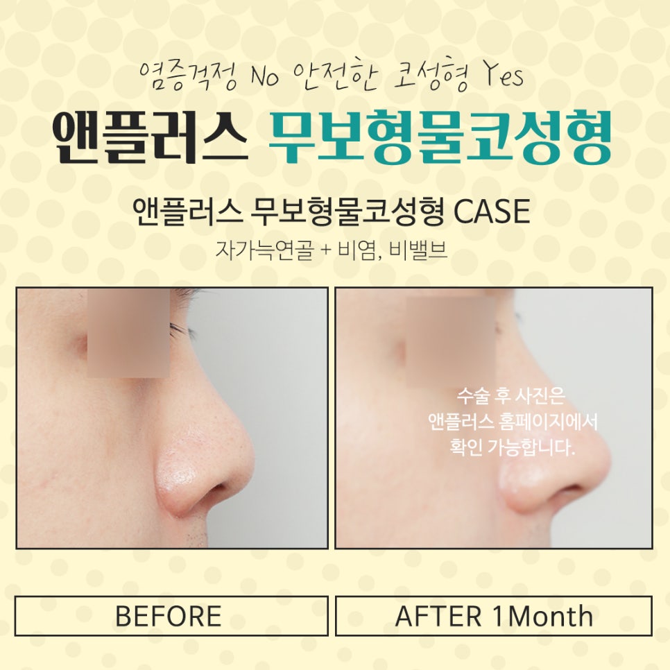 Natural Image Improvement with Non-Implant Nose Surgery image 13