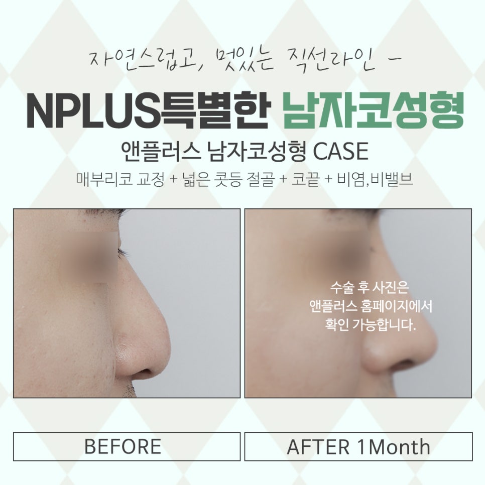 Learn More About Male Rhinoplasty Reviews in Detail image 15