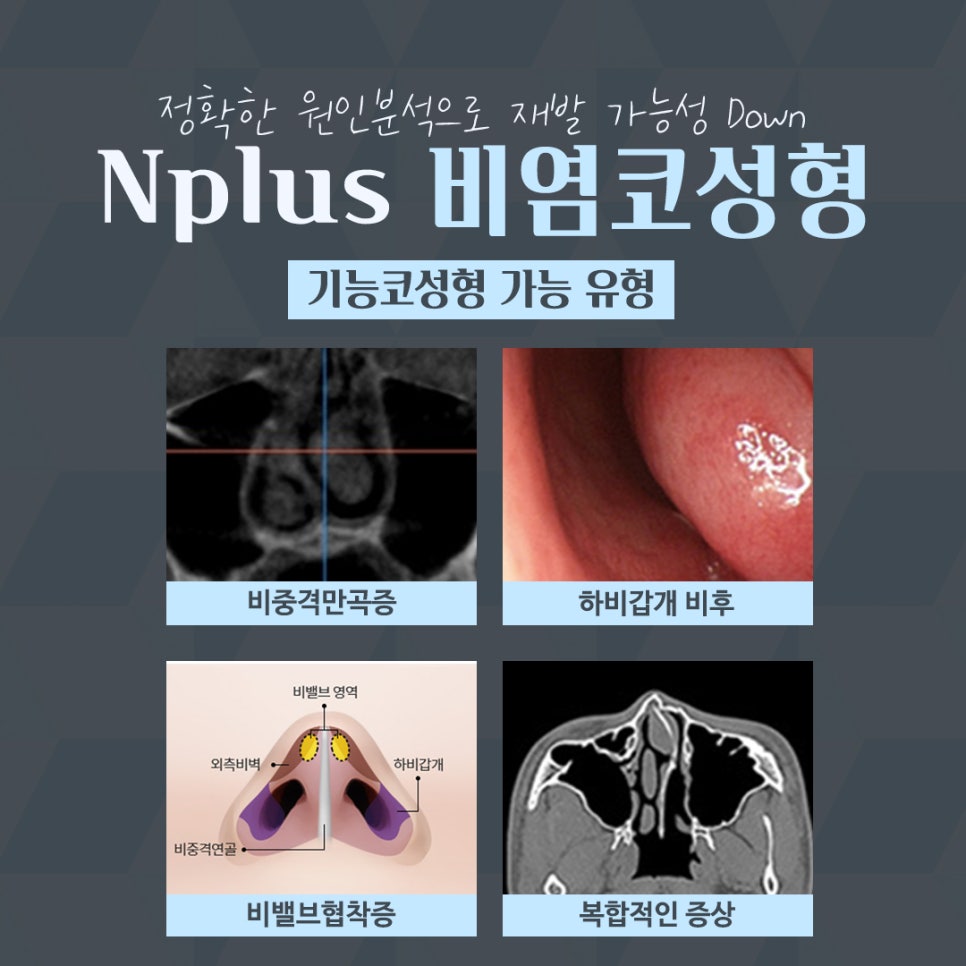 비염수술 방법과 후기까지 관련 이미지 6