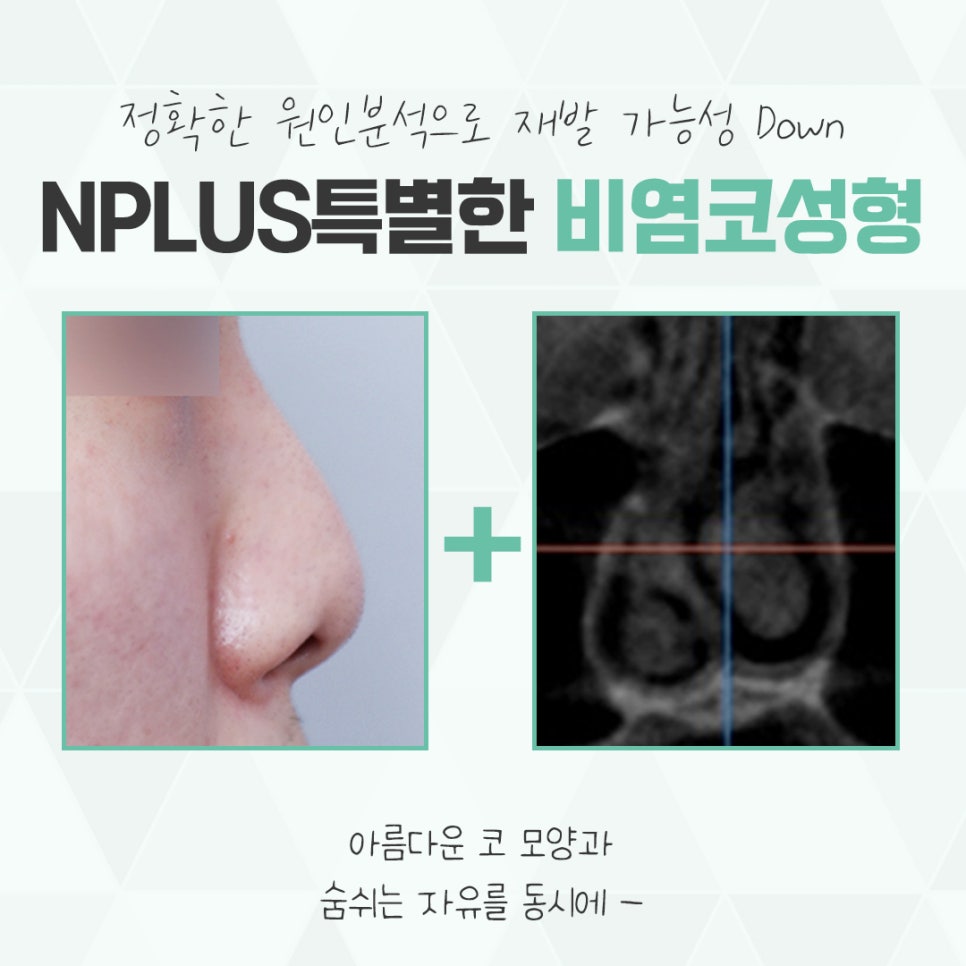 Check Nasal Surgery and Rhinoplasty in Detail image 3