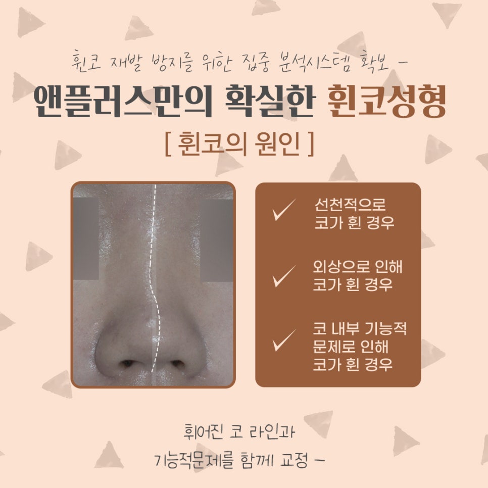 Crooked Nose Surgery Review, Including Functional Improvement image 4