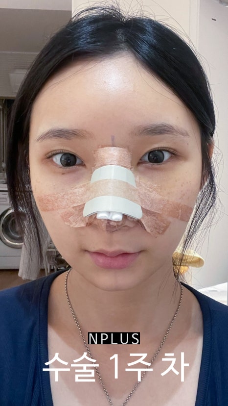 기본코성형후기 절골 + 무보형물 코성형 + 코끝 비중격 연골, 귀 연골 관련 이미지 3