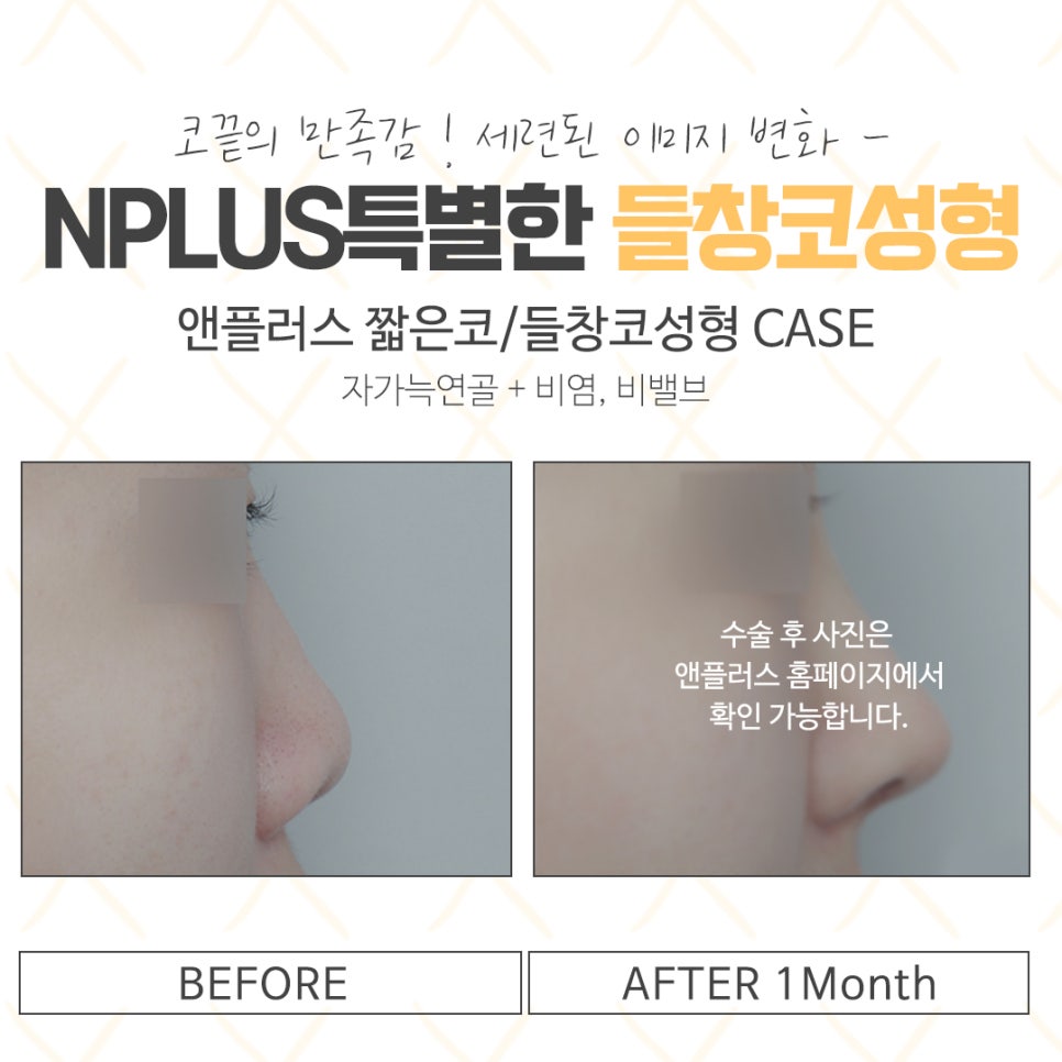 들창코수술에 대해 자세하게 알아보고 관련 이미지 15