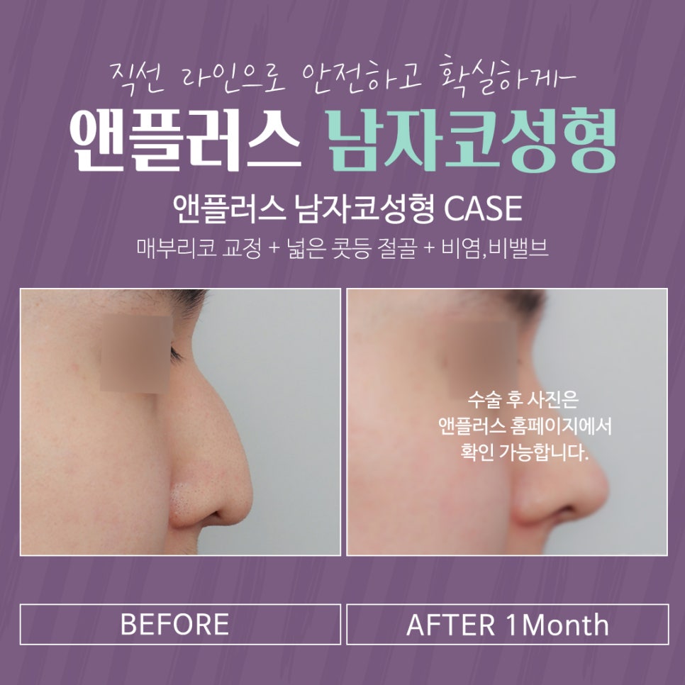 Male Nose Surgery Review, Including the Inside Examination image 15