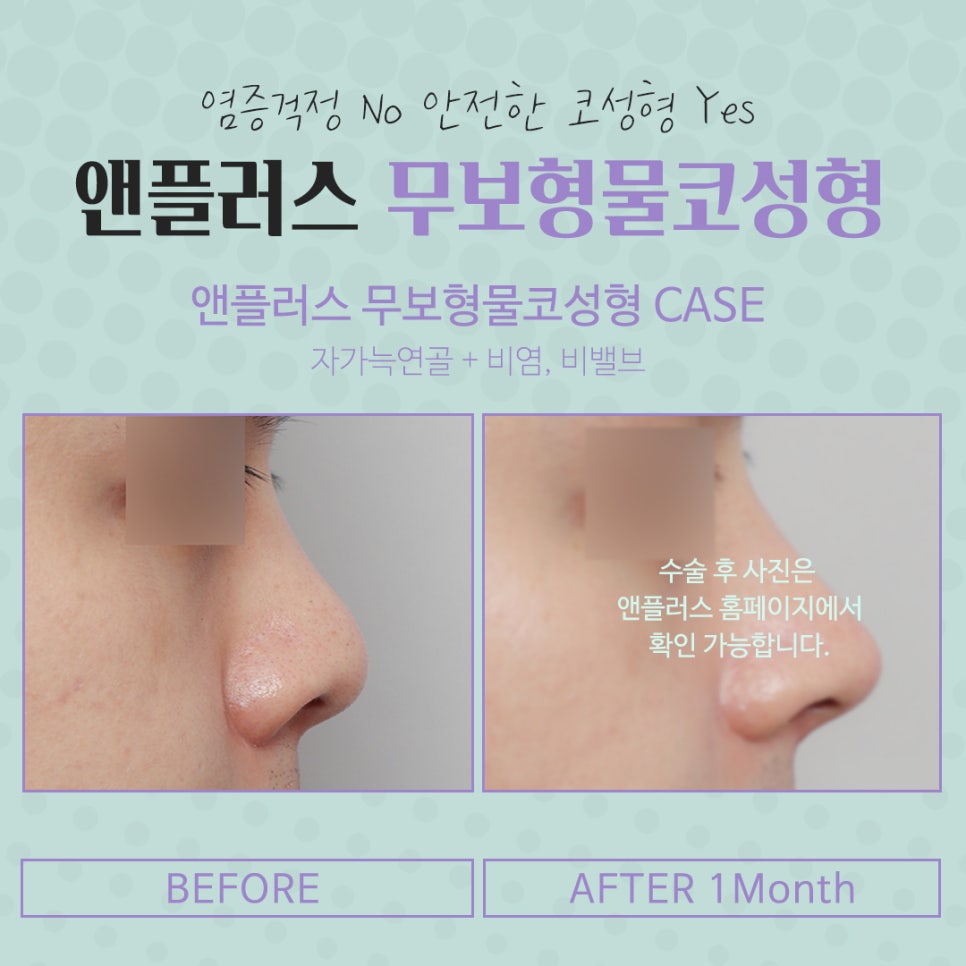 Safety First: Check Reviews of Non-Implant Rhinoplasty image 7