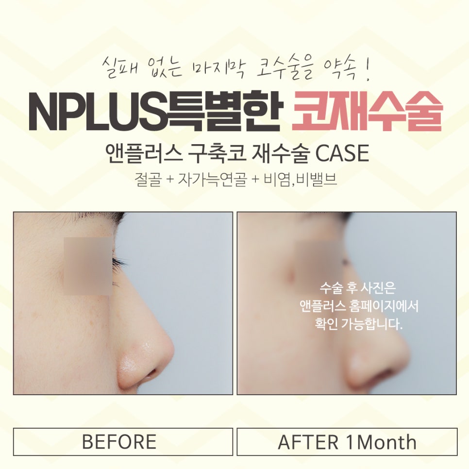 코재수술성형외과 차이를 알아보고 관련 이미지 14