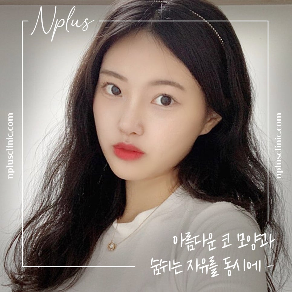 코성형 후기로 알아보고 결정 관련 이미지 16