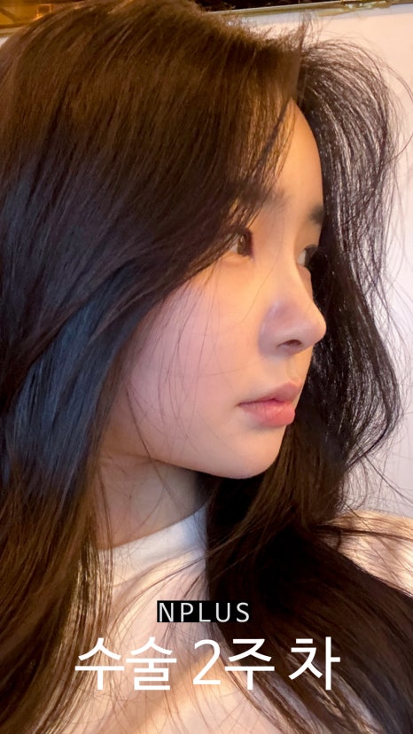 AN Plus Plastic Surgery Review: Silicone Nasal Bridge, Autologous Rib Cartilage Nasal Tip, Under-Eye Fat Repositioning, Fat Grafting image 7
