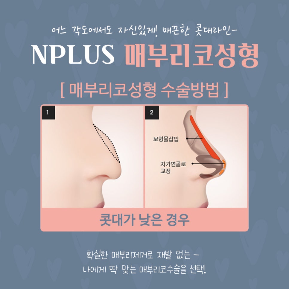매부리코수술 후기까지 확인하고 관련 이미지 11