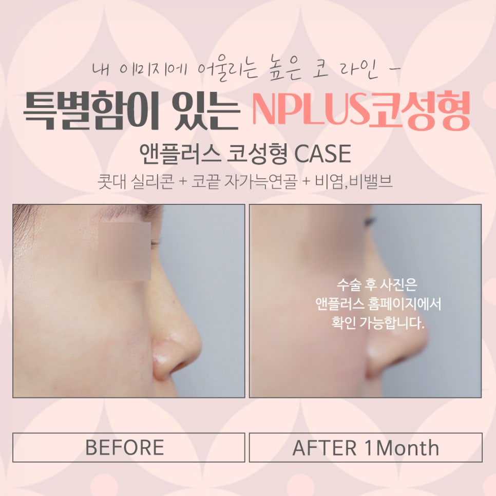 코수술 후기까지 확인하여 세련된 코라인으로 관련 이미지 15