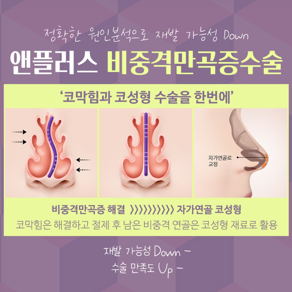 비중격만곡증수술후기 라인까지 고려해서 관련 이미지 10