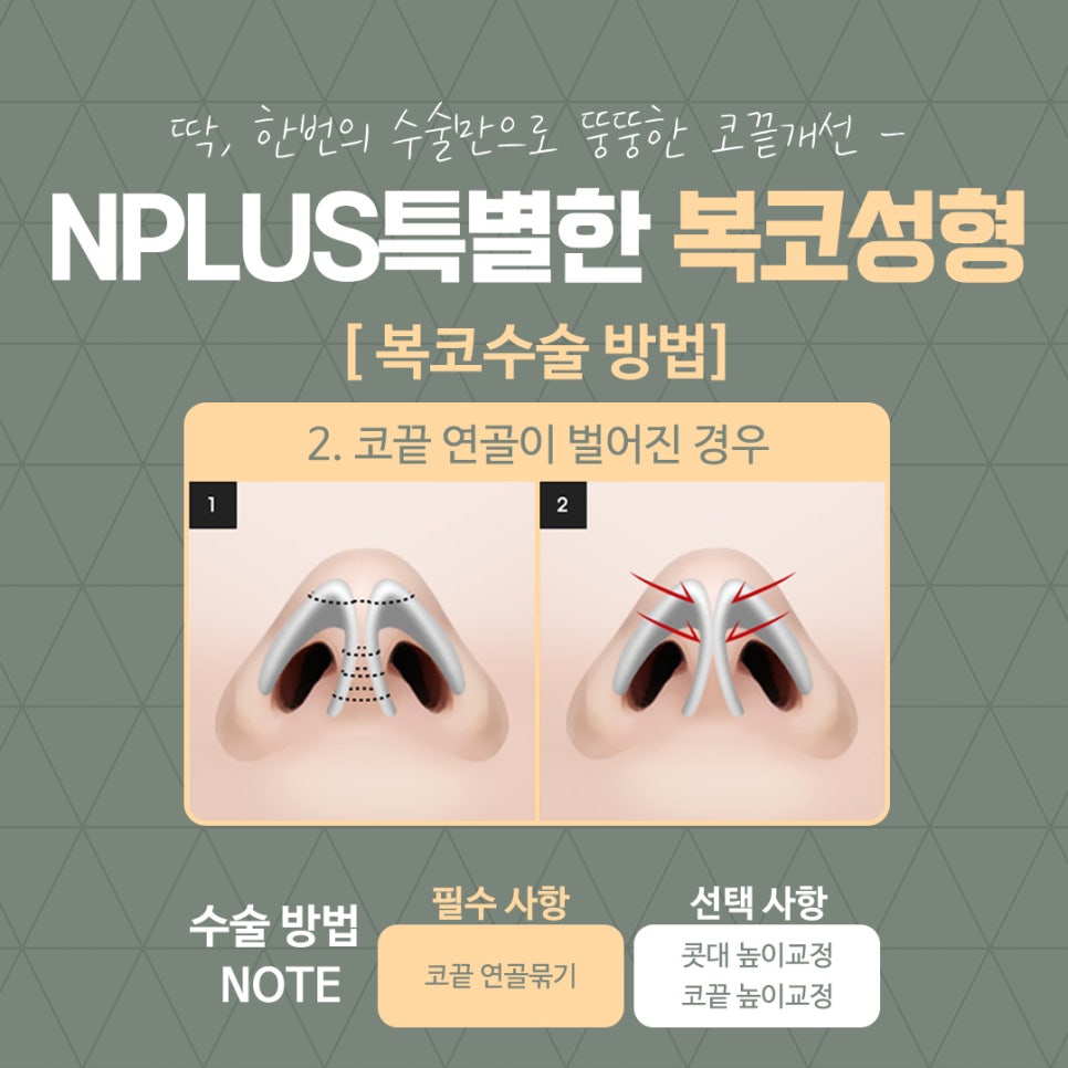 복코성형으로 세련된 이미지 변신 관련 이미지 10