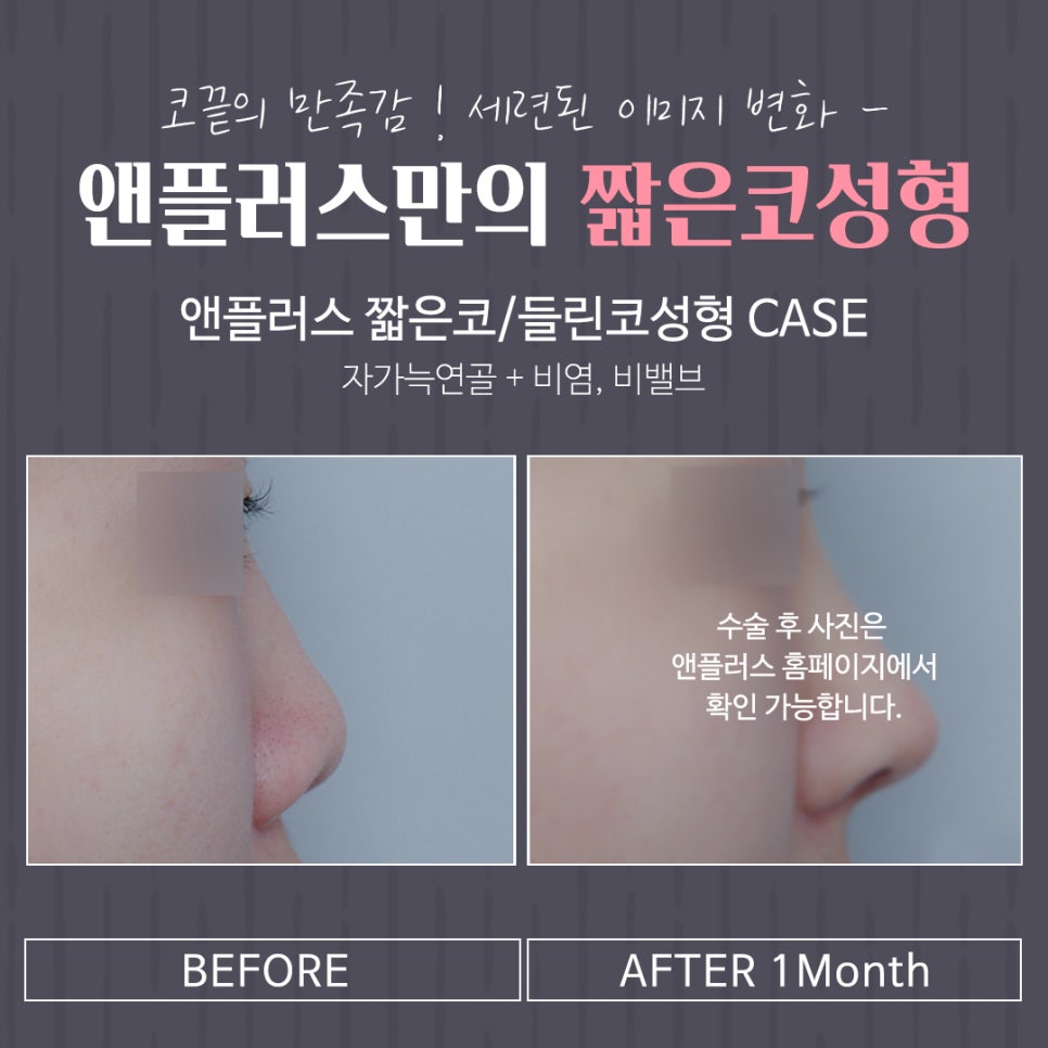 Image Transformation Through Upturned Nose Surgery image 15