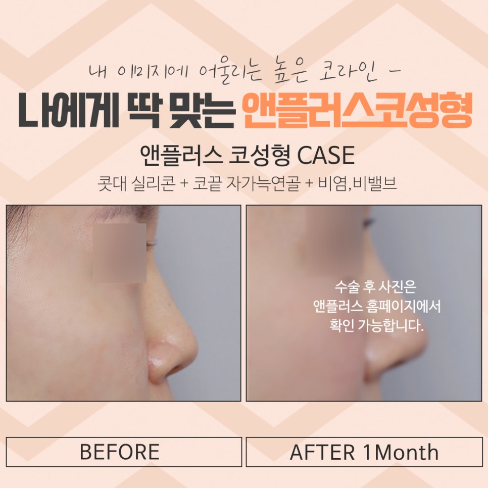 코성형 후기로 알아보고 결정 관련 이미지 17