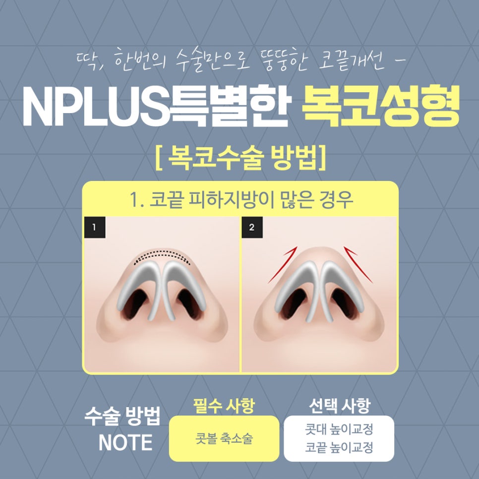 복코수술후기를 통해 예쁜 코라인으로 관련 이미지 9