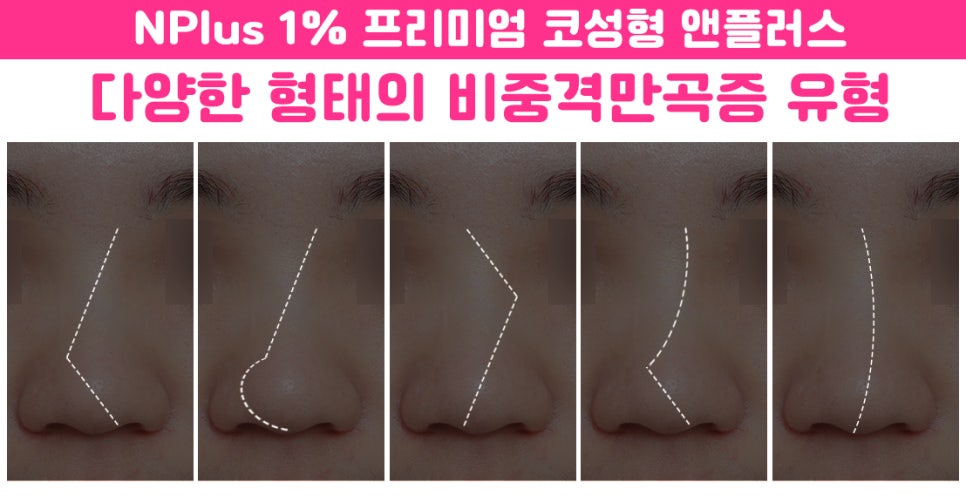 Septoplasty Surgery: A Careful Look From the Inside image 3