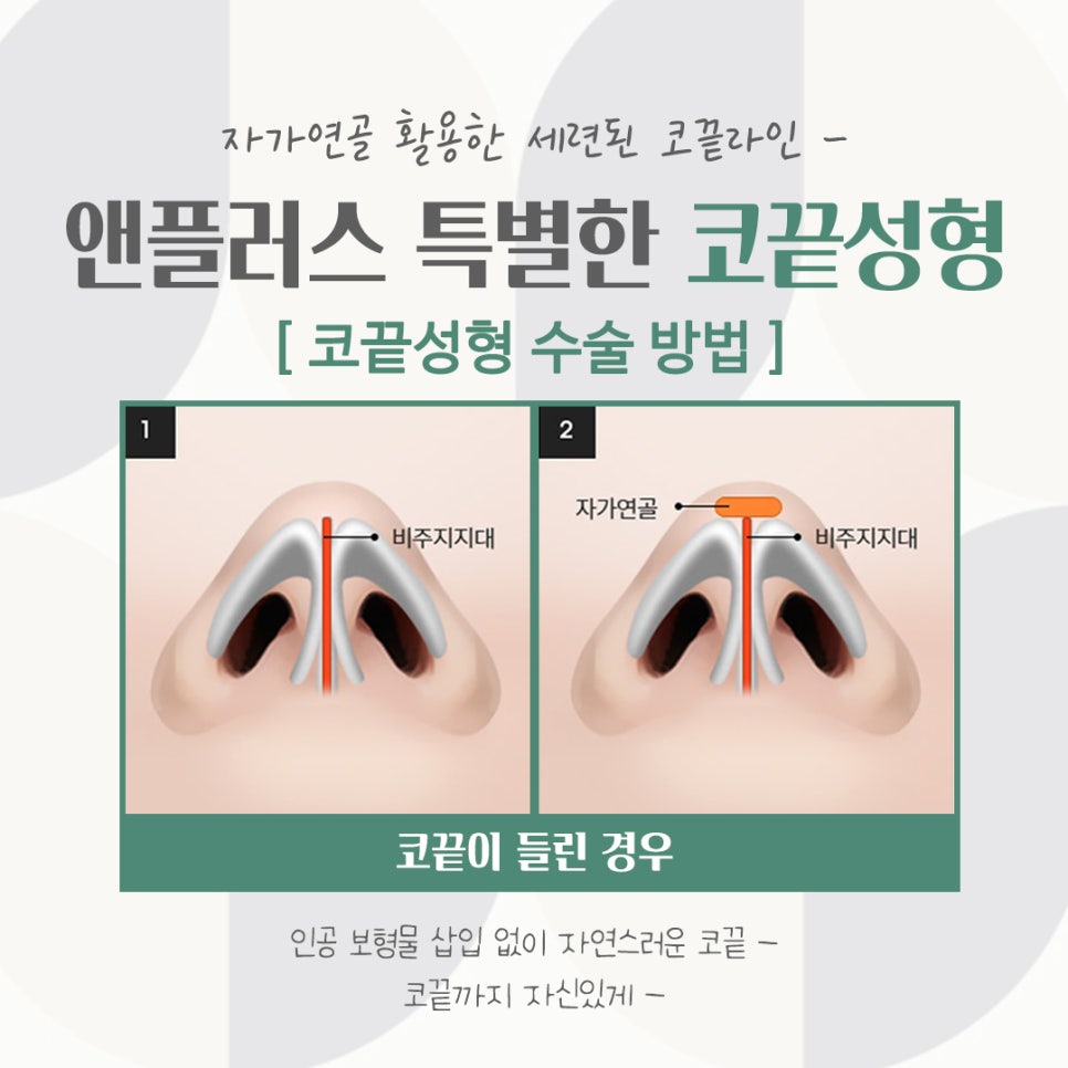 코끝연골묶기로 자연스러운 코라인 관련 이미지 8