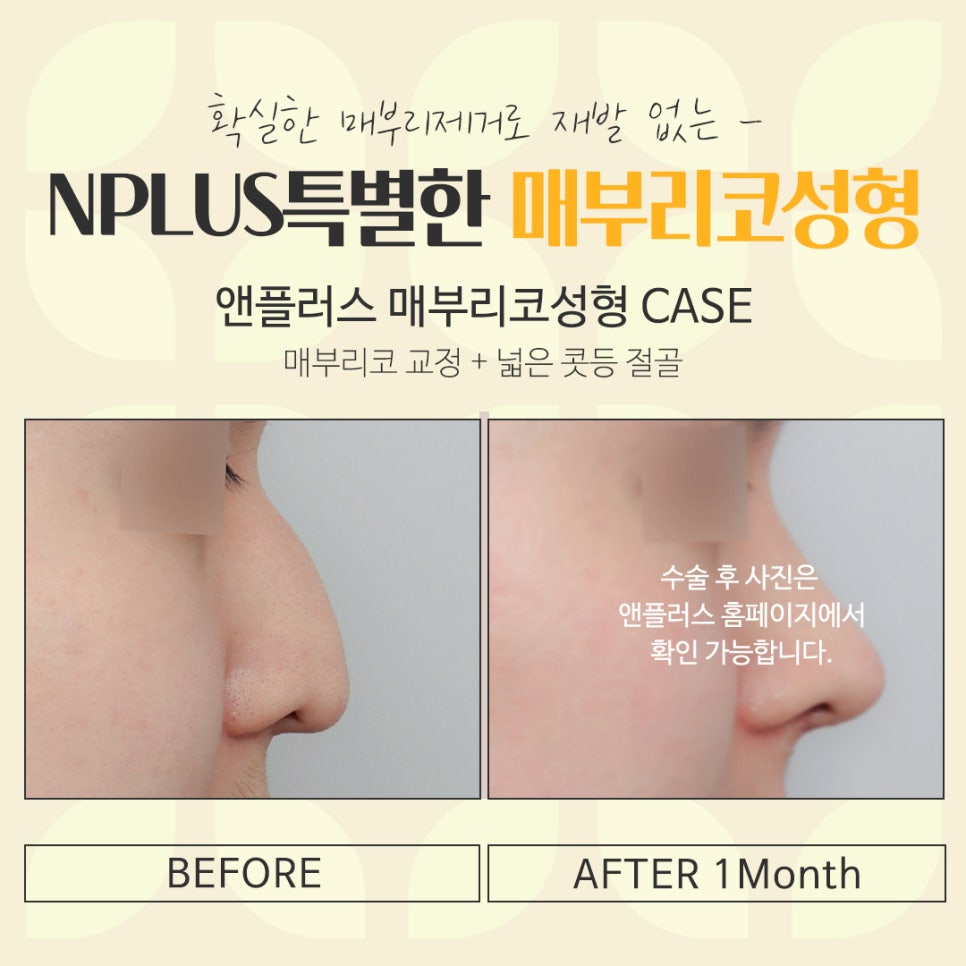 Detailed Review of Hump Nose Surgery, Including Function image 16