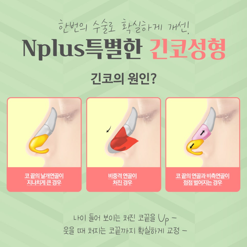 Long Nose Surgery: From Looking Older to Looking Younger image 3