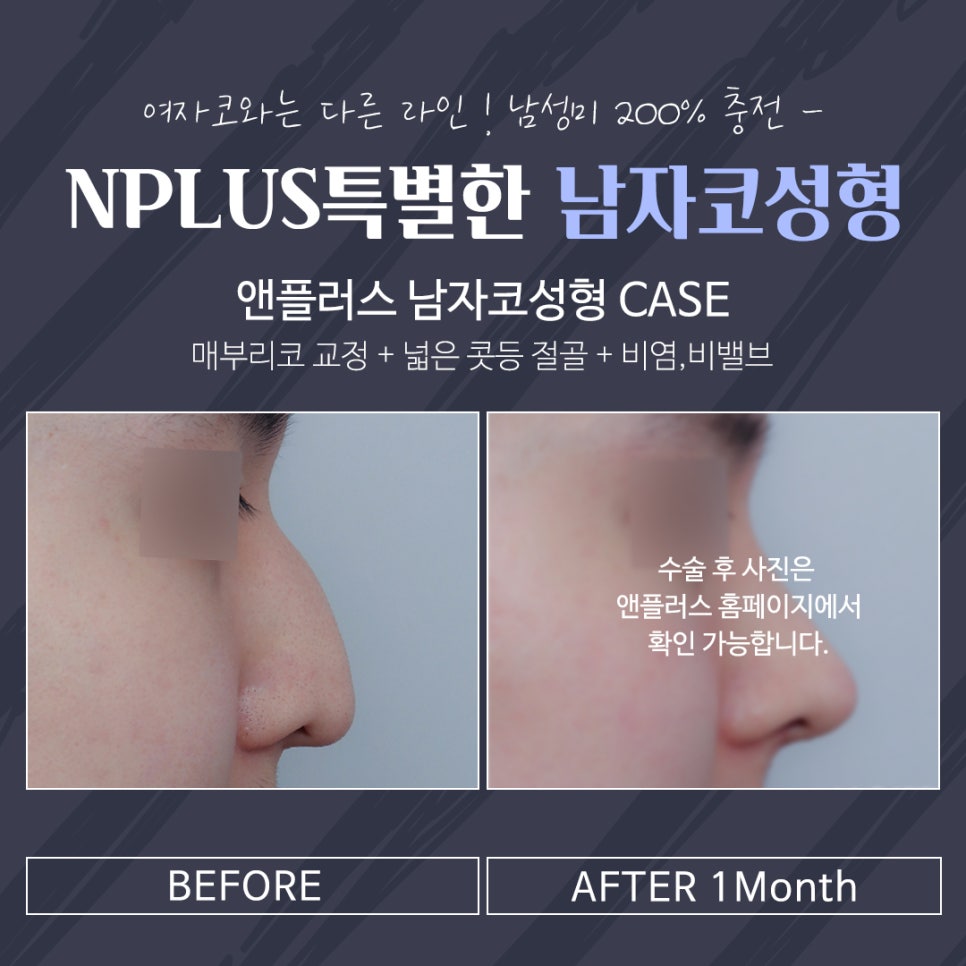 Rhinoplasty Review for Improving a Large Male Nose image 4