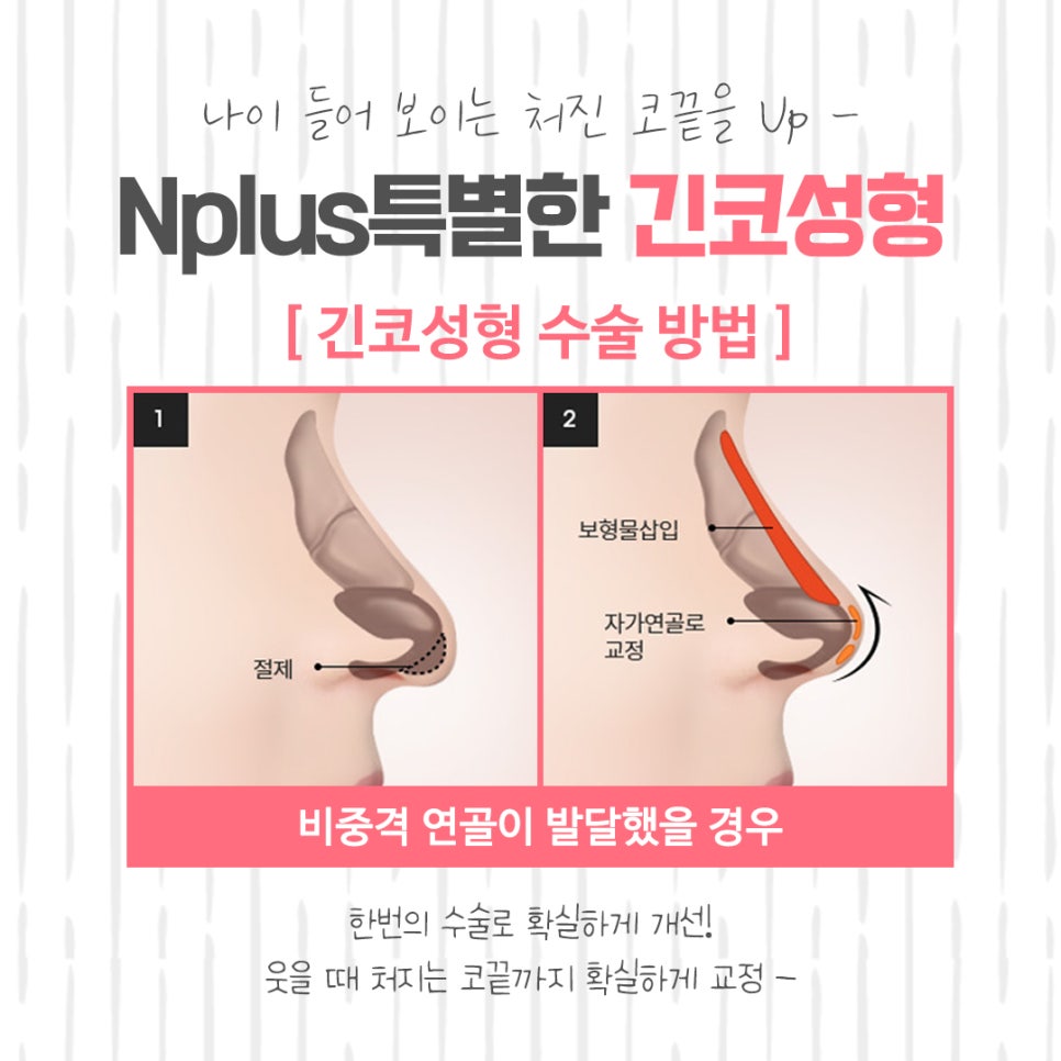 긴코성형 후기까지 알아보고 관련 이미지 8
