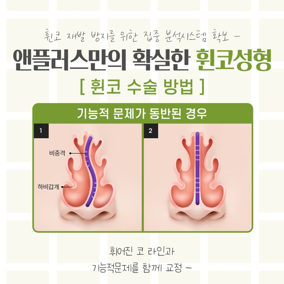 휜코수술에 대해 자세하게 확인하고 관련 이미지 10
