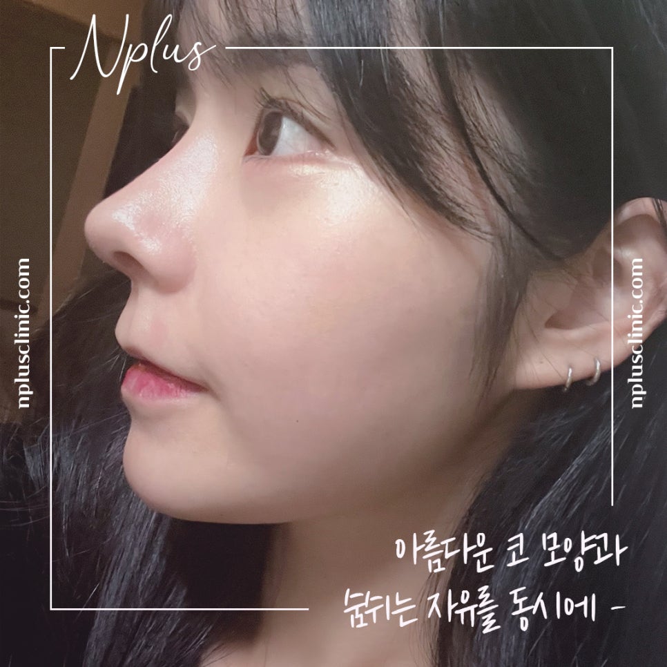 Learn in Detail About Rhinoplasty for Rhinitis image 2
